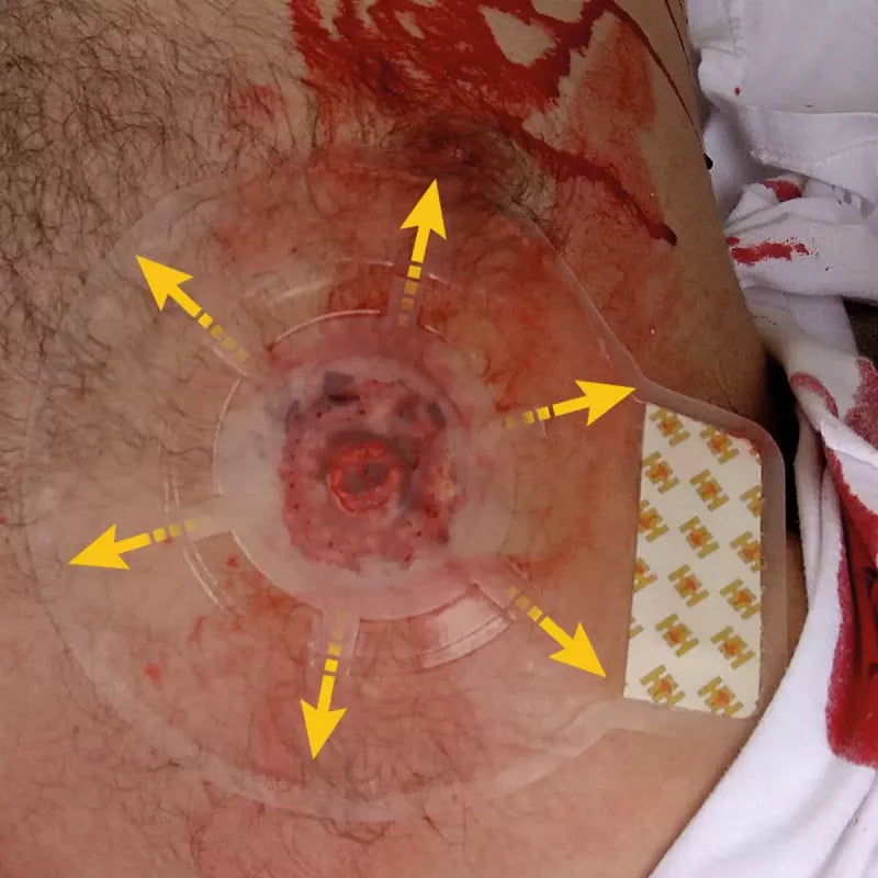 H-Vent Chest Seal